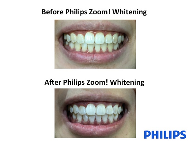 Pairing Teeth Whitening With Spa Treatment – Now That’s A First!